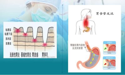 婴儿胃食管反流，两个月大的挑战与应对策略